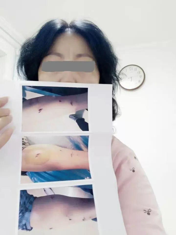 女子被狗咬傷，輾轉打疫苗花費2萬多